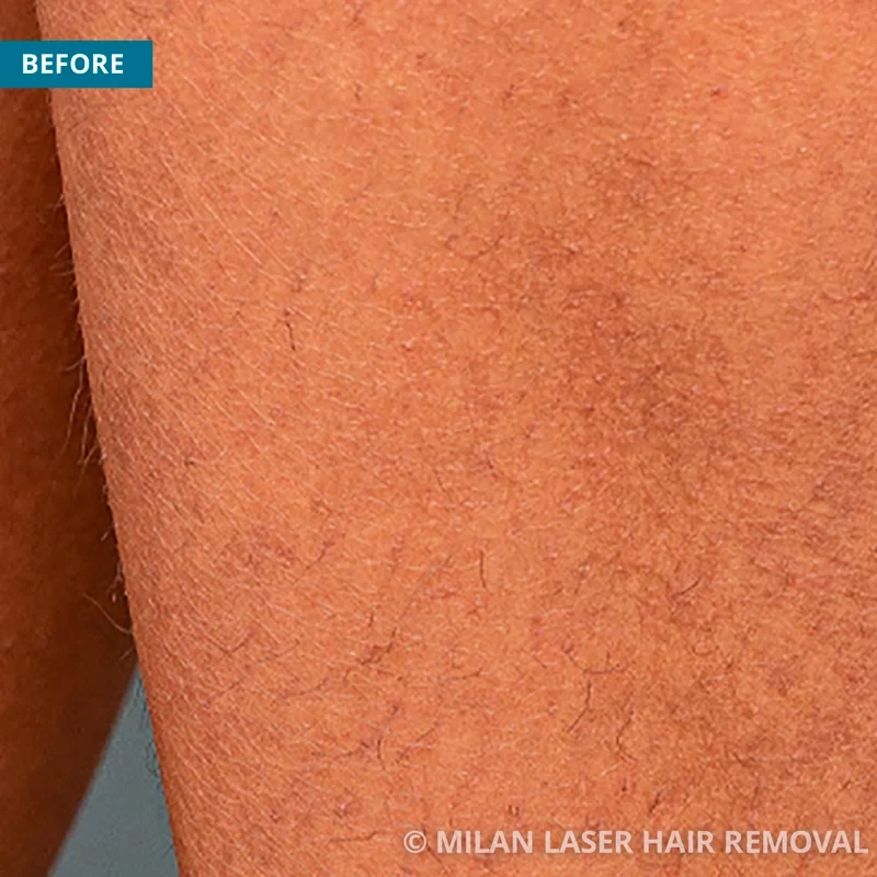 Before photo of a legs prior to getting our legs laser hair removal treatment